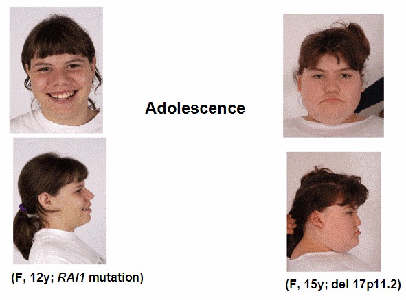 Рисунок 3. Девочки-подростки с СМС, вызванным мутацией гена RAI1 (слева) и делецией 17p11.2 (справа).